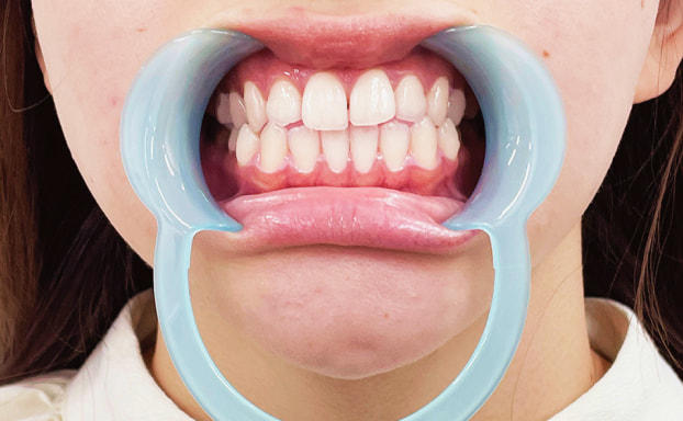 1.マウスオープナーを装着する