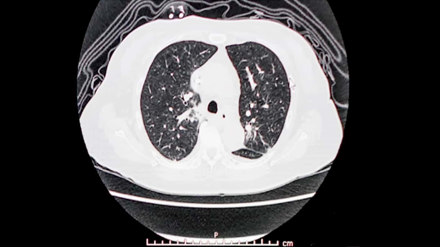 胸部/腹部CT検査で何がわかるの?